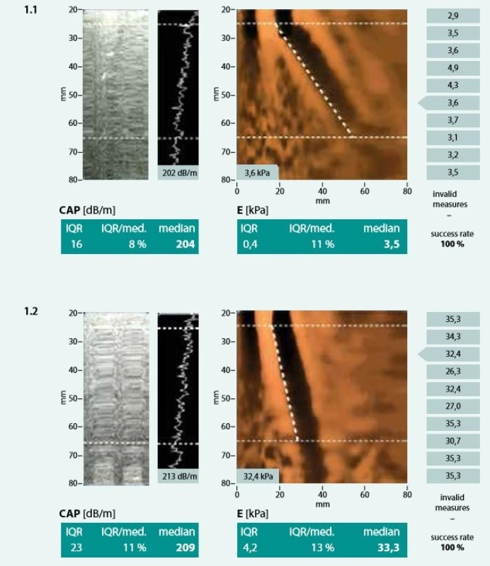 Měření přístrojem FibroScan: 1.1 – normální játra 1.2 – cirhotická játra. Výsledkem měření je hodnota
tuhosti jaterní tkáně E udávaná v kPa a hodnota CAP v dB/m spolu s parametry kvality měření. Upraveno
podle [3]