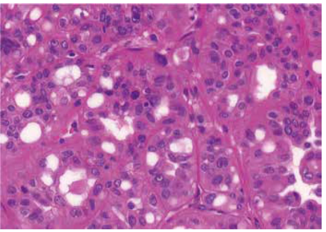 Deep red macronucleoli and perinucleolar clearing in same case,
showed in Figure 1. HE 400x