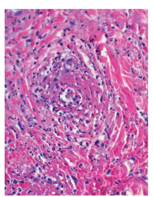 Leukocytoklastická vaskulitida: eozinofilní depozita
fibrinu ve stěnách cév, erytrocytární extravazáty, neutrofily
s fragmentací jader – leukocytoklazií (HE 400x)