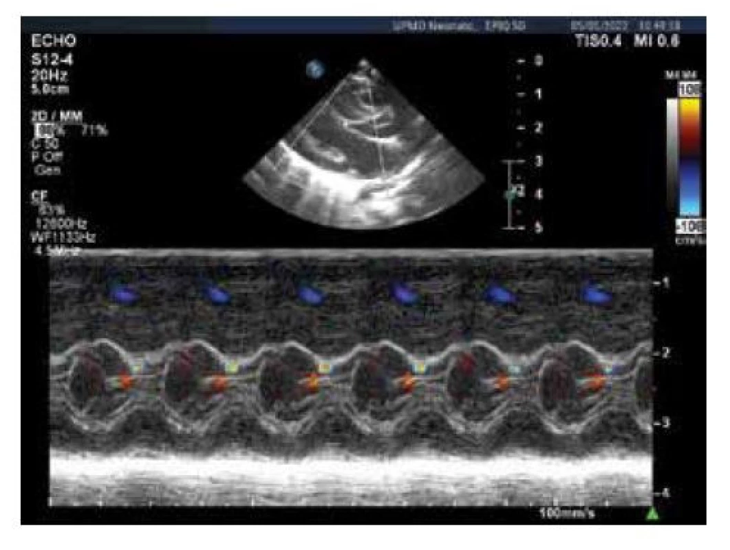 Echokardiografie, barevný M-mode levé komory,
střední hypertrofie komorového septa s akcelerací toku
mezi předním cípem mitrální chlopně a komorovým septem
(modrožlutý turbulentní signál)