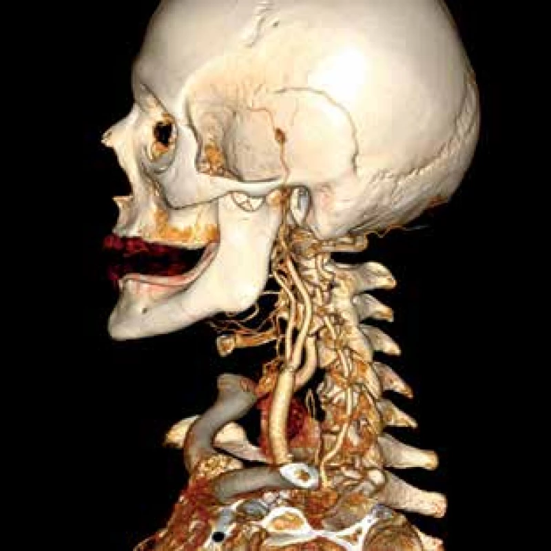 Subklavio-karotický bypass<br>
Fig. 3: Subclavian-to-carotid bypass