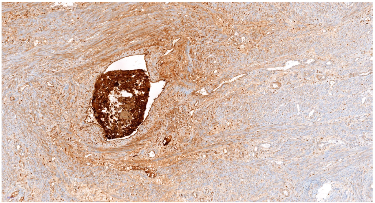 Invaze trofoblastu do cévy – hCG
