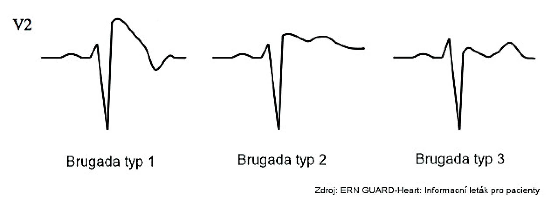 Syndrom Brugadových typ 1, 2 a 3.