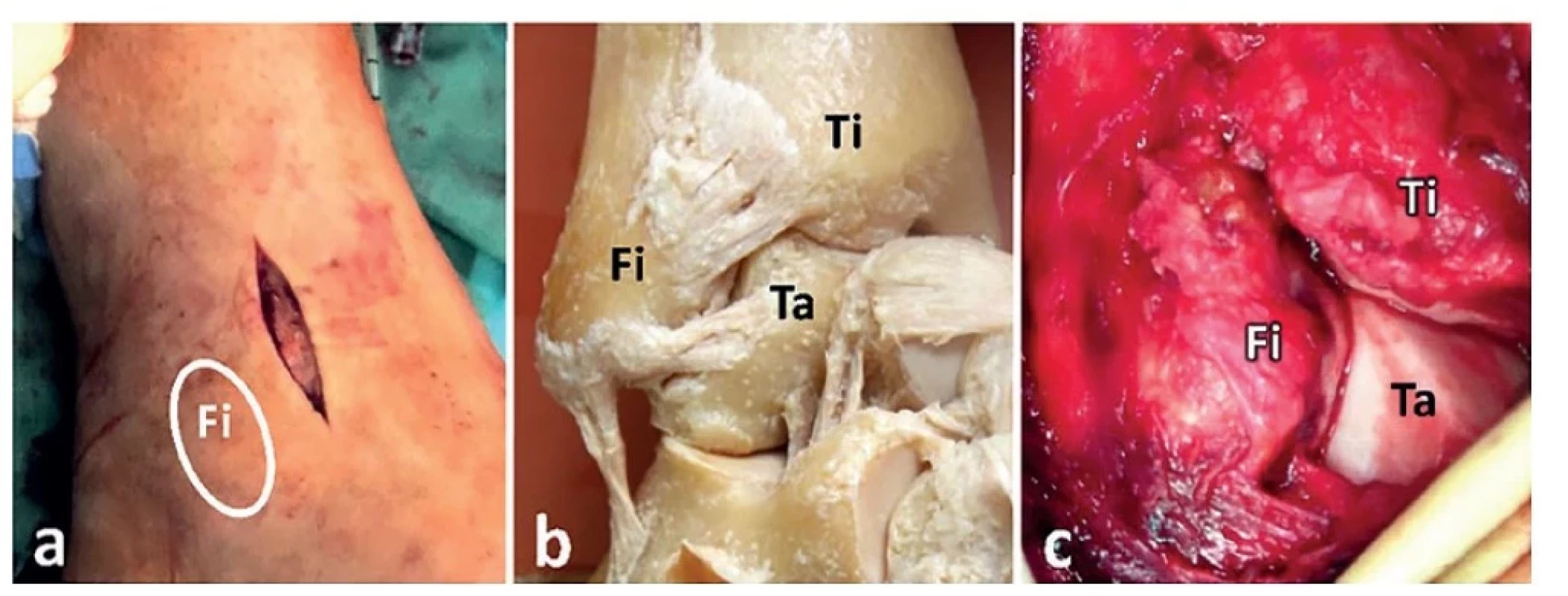 Otevřená repozice distální fibuly do incisura fibularis tibiae<br>
(a – anterolaterální přístup (Fi – projekce zevního kotníku), b – anatomický preparát, anterolaterální oblast pravého
hlezna, c – oblast tří rohů, tj. Tillaux-Chaputova hrbolku, Wagstaffova hrbolku a laterální hrany kladky talu. Fi – fibula,
Ti – tibie, Ta – talus.)<br>
Fig. 7: Open reduction of the distal fibula into the fibular notch<br>
(a – anterolateral approach (Fi – lateral malleolus projection), b – anatomical specimen, anterolateral region of
the right ankle, c – “three corners” area, i.e., Tillaux-Chaput tubercle, Wagstaff tubercle and lateral crest of the talar
dome. Fi – fibula, Ti – tibia, Ta – talus.)