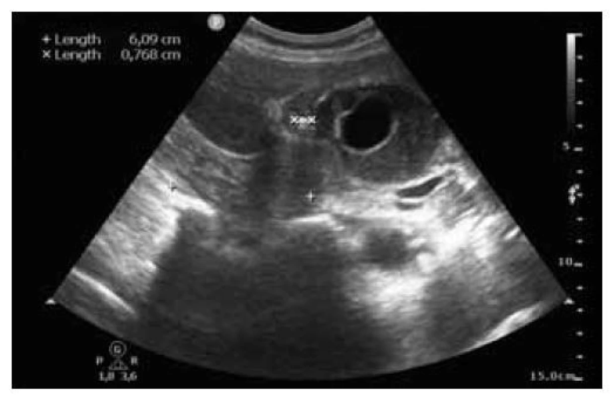 Transabdominální sonografie: vícečetná cholecystolitiáza
v krčku a nasedající solidně-cystické ložisko.<br>
Fig. 1. Transabdominal sonography: multiple cholecystolithiasis
in the neck and an onset solid-cystic lesion.