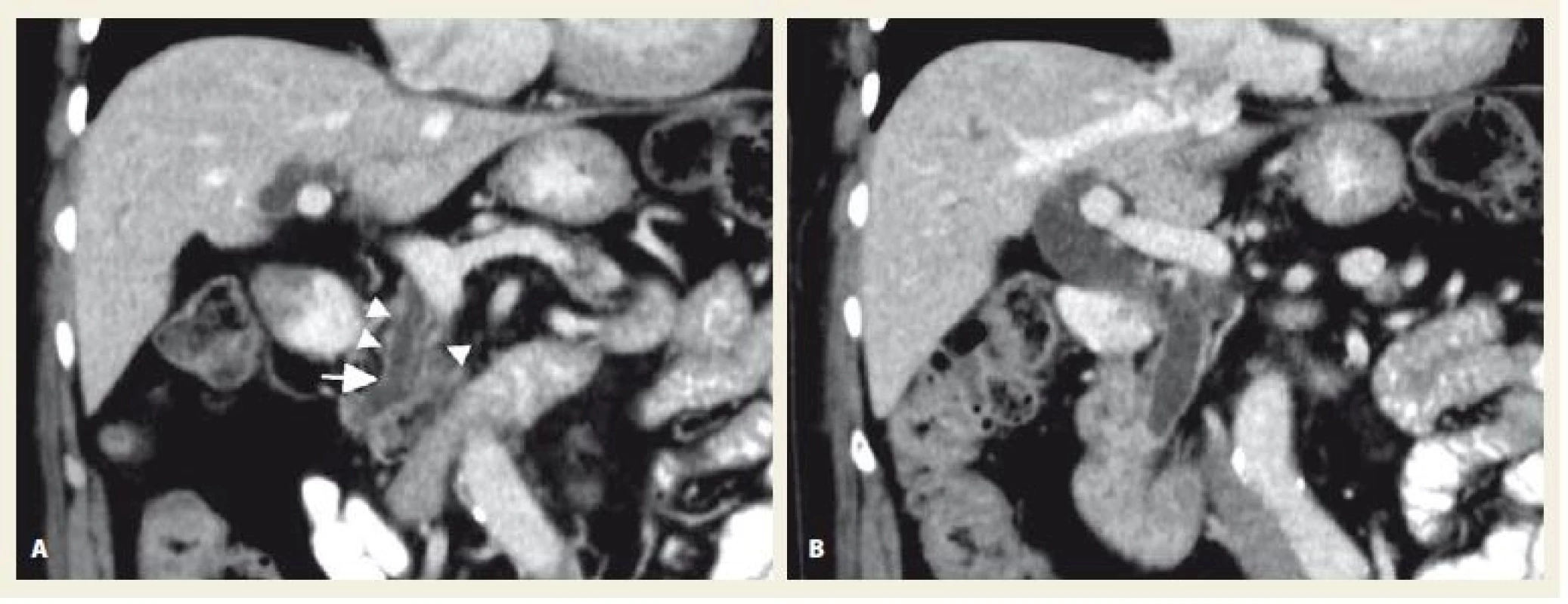 A, B. Portal venous phase of contrast-enhanced CT – image A shows the dilatation of pancreatic duct (arrow) and
pancreatic head atrophy (arrowheads), image B reveals marked dilatation of extrahepatic bile ducts, so-called double
duct sign refers to the presence of obstruction of both ducts, frequently due to tumour invasion. Source: Department of
Radiology, Hospital Uherské Hradiště.<br>
Obr. 1. A, B. Portovenózní fáze kontrastního CT – obrázek A ukazuje dilataci pankreatického duktu (šipka) a atrofii hlavy pankreatu
(větší šipky), obrázek B ukazuje výraznou dilataci extrahepatálních žlučových cest, tzv. double duct sign poukazuje na
přítomnost obstrukce obou vývodů, často kvůli nádorové invazi. Zdroj: Radiologické oddělení, nemocnice Uherské Hradiště.