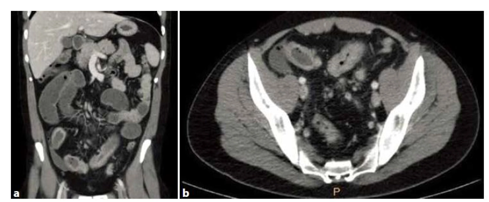 a, b: CT nález ileózního stavu se stenotizací a zánětlivým postižením 25 cm terminálního ilea s mezikličkovou fistulací
Fig. 1a, b: CT showing bowel obstruction with stenosis and inflammation of terminal ileum in the length of 25 cm with
intestinal fistula