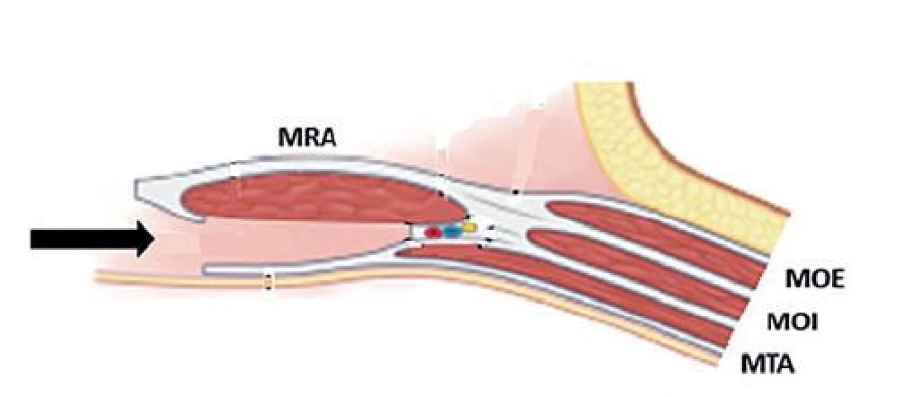 Přístup do retromuskulárního prostoru<br>
Fig. 3: Retromuscular approach