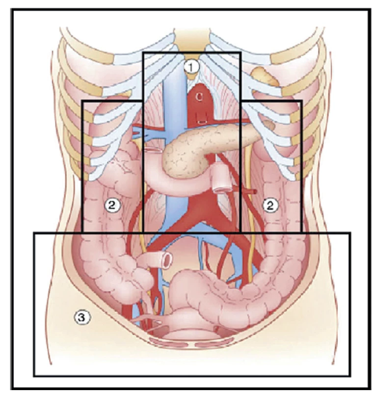 Zobrazení zón retroperitoneálního krvácení
(Martin, et al. [3])<br>
Fig. 1: Imaging of retroperitoneal bleeding zones
(Martin, et al. [3])