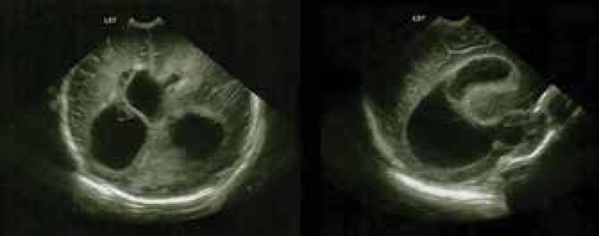 Ultrasonographic finding of asymmetry and dilation of lateral
brain ventricles – bilateral frontally present hyperechogenicity
and evident signs of previous ventriculitis