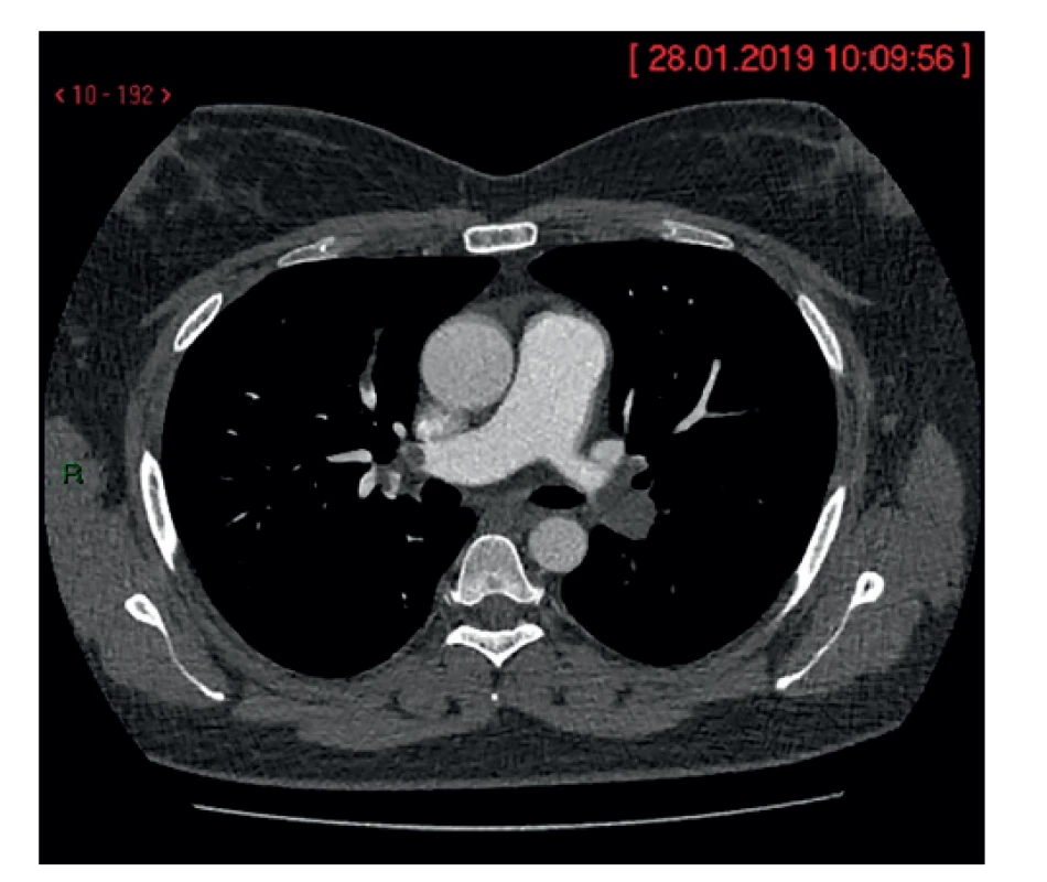 Nádorový embolus v pravom a ľavom ramene
pľúcnice<br>
Fig. 2: Tumor embolus in the right and left branches of the
pulmonary artery