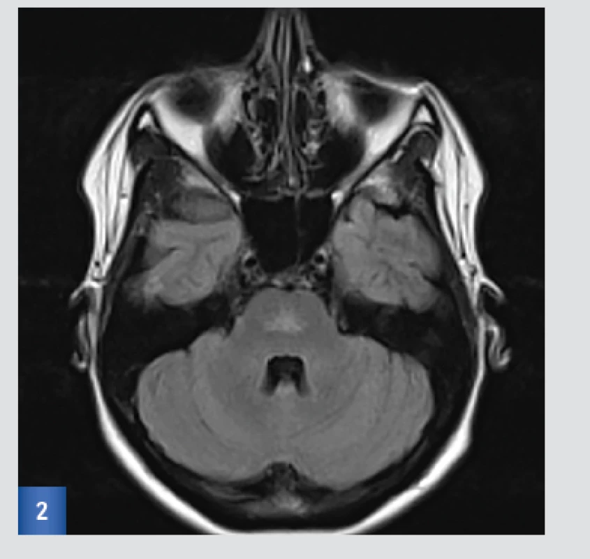 Vstupní MRI: FLAIR