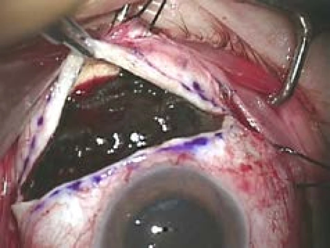 Exoresection of uveal melanoma 