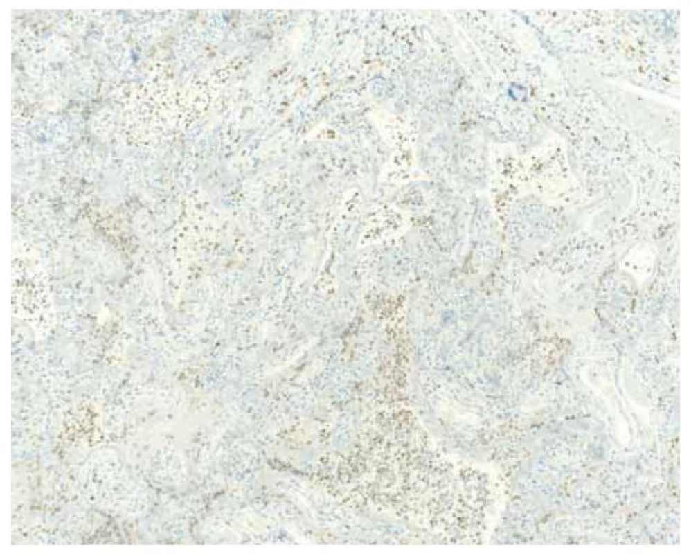 Pozitivní imunohistochemické barvení pomocí protilátky CD68, prokazující
histiocytární intervilositidu, jeden z charakteristických rysů SARS-CoV-2
placentitidy.<br>
Fig. 4. Positive immunohistochemical staining with CD68 antibody, demonstrating
histiocytic intervilositis, one of the characteristic features of SARS-CoV-2 placenitis.