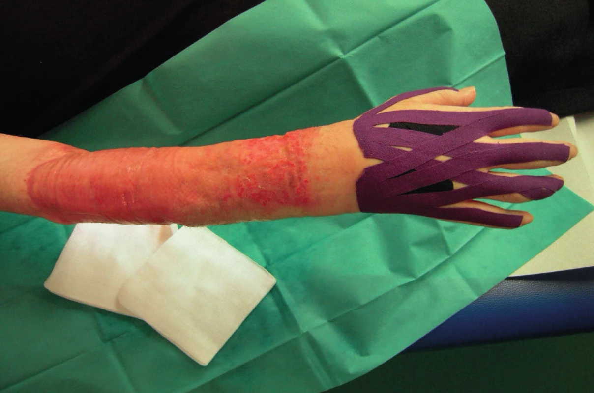 The fully healed skin defect two weeks after autotransplantation of a dermo-epidermal graft (8 weeks after primary Integra® application)
