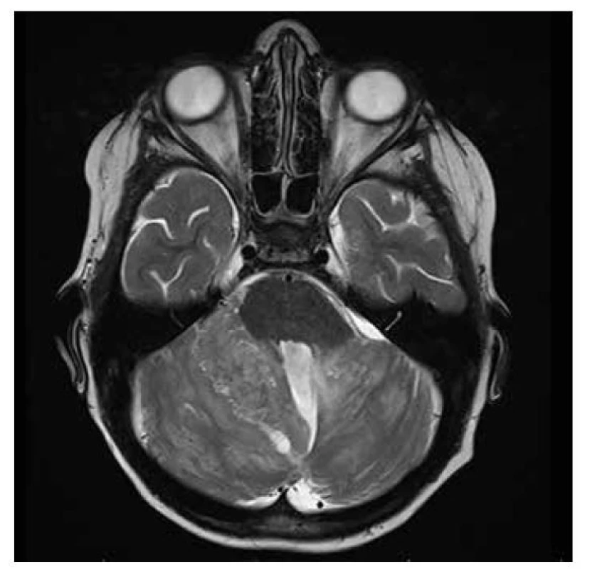 Meduloblastom group 3: rozsáhlá infratentoriální infiltrace, expandujícího
charakteru, s převážně leptomeningeálním postižením, nehomogenně
vyššího signálu v T2W čase, s restrikcí difuze při proliferativně aktivní lézi.
