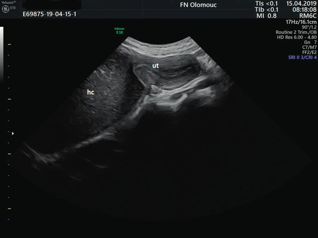 Ultrazvukový snímek hematokolpos v sagitální projekci
abdominální sondou
ut – uterus, hc – hematokolpos