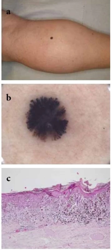  a-c. Melanoma in situ s dermatoskopickým obrazem připomínajícím
Reedův névus u dospělého pacienta