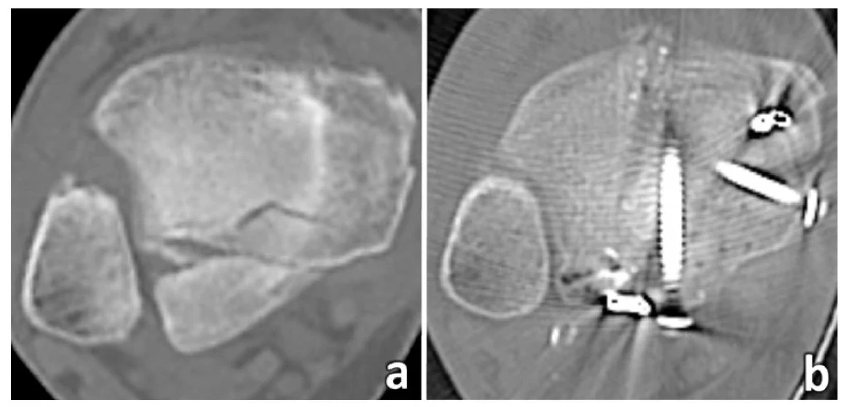 Význam rekonstrukce incisura fibularis tibiae pro úspěšnou repozici distální fibuly<br>
(a – CT transverzální řez ukazuje odlomení malleolus posterior nesoucího zadní třetinu incisury, b – repozici fibuly
předcházela repozice a fixace malleolus posterior z posterolaterálního přístupu, následně provedena anatomická
repozice distální fibuly.)<br>
Fig. 5: Importance of reconstruction of the fibular notch for a successful reduction of the distal fibula<br>
(a – CT axial scan shows avulsion of the posterior malleolus carrying the posterior third of the notch, b – reduction
of the fibula was preceded by reduction and fixation of the posterior malleolus from the posterolateral approach,
and followed by anatomical reduction of the distal fibula.)