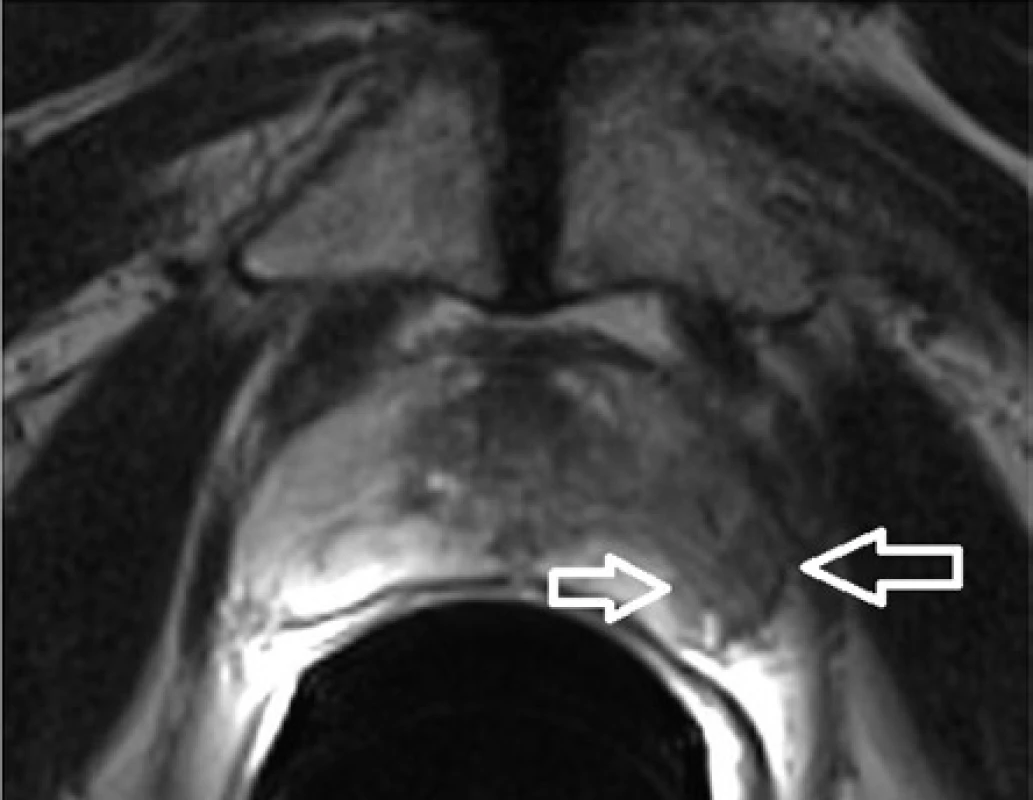 T2 transverzální sken prostaty, šipky vyznačují
nádor v periferní zóně, nádor je T2 hyposignální<br>
Fig. 1. T2 transversel scan of the prostate, the arrows
indicate the tumor in the peripheral zone, the tumor is
T2 hyposignal