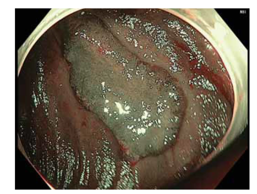 Povrchová neoplastická léze 0–IIa + IIc dle
Pařížské klasifikace vel. 25 mm ascendens v zobrazení NBI
(Narrow Band Imaging).<br>
Fig. 1. Superficial neoplastic lesion 0–IIa + IIc according to
the Paris classification size25 mm ascendens in NBI (Narrow
Band Imaging).