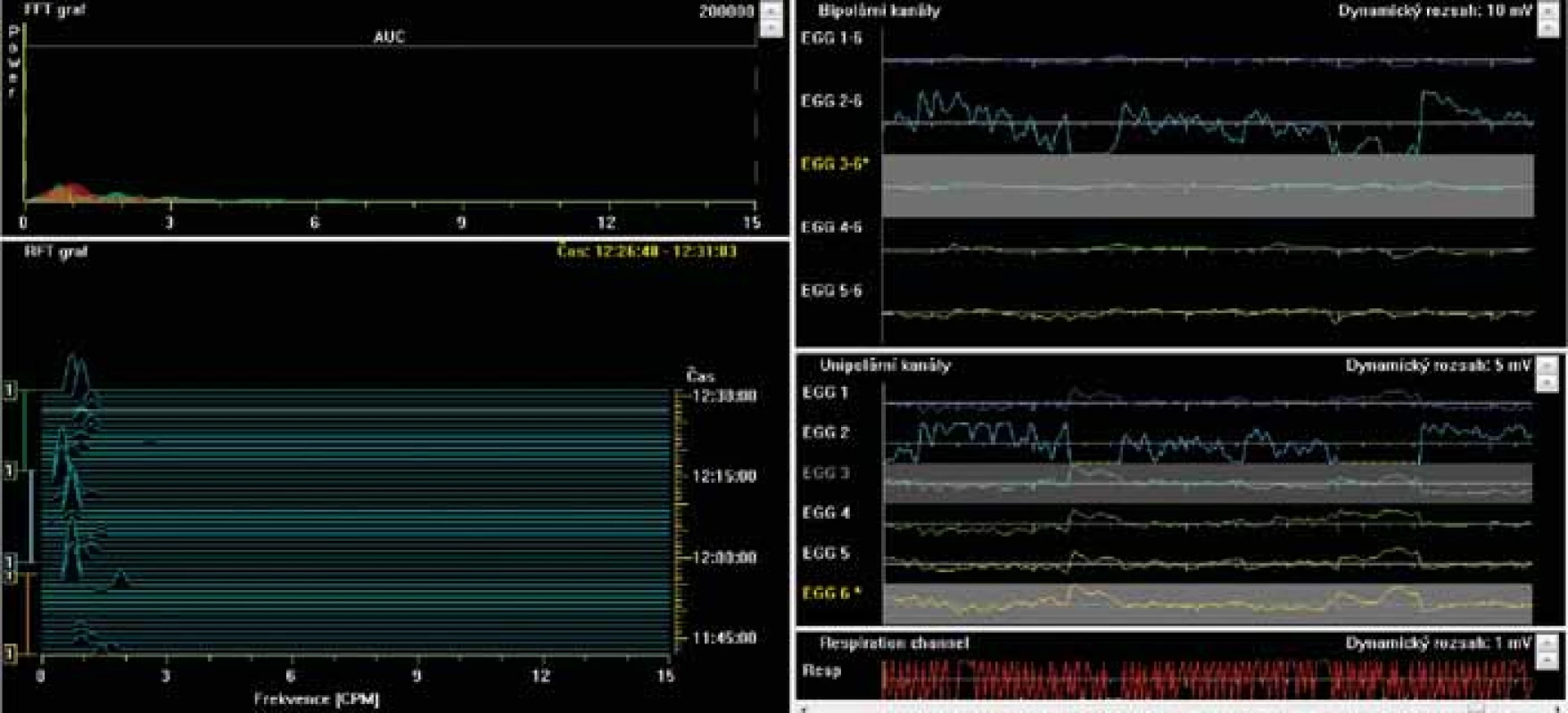 Electrogastrography. Bradygastria. Low power (areas of amplitudes).<br>
Elektrogastrografie. Bradygastrie. Nízká elektrogastrografická síla (plocha pod křivkou).