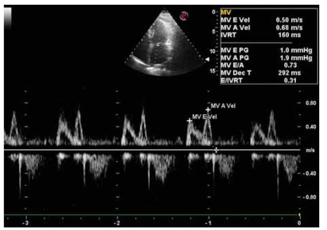 Echokardiografický nález diastolickej dysfunkcie ľavej komory vo fáze
relaxácie.<br>
Fig. 6. Echocardiographic finding of left ventricular diastolic dysfunction in the relaxation
phase.