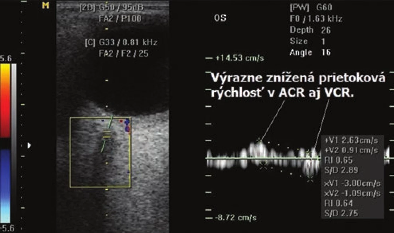 Výrazné zníženie prietokovej rýchlosti v arteria centralis retinae pri priamej karotído-kavernóznej fistule ipsilaterálne oproti druhému oku