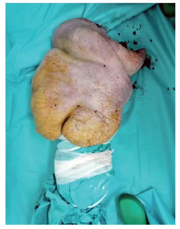 Amputovaná pravá dolná končatina<br>
Fig. 3: Amputated right lower limb