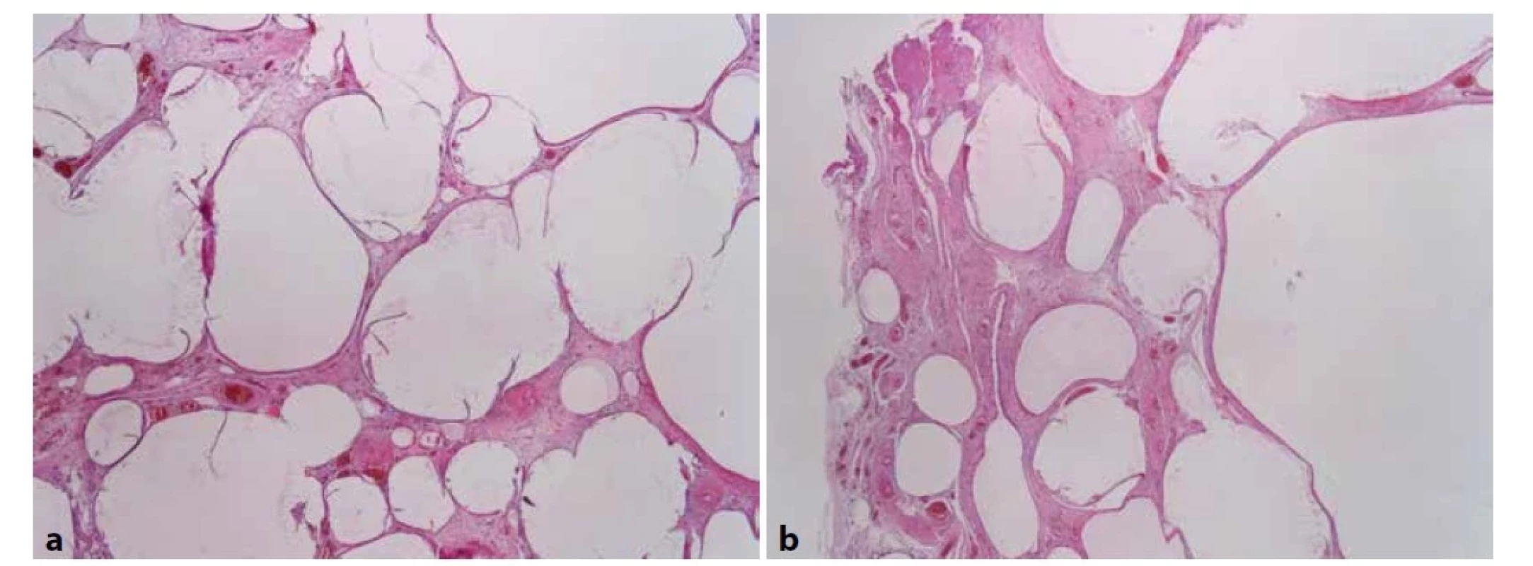 a, b Histologické vyšetření preparátu po barvení hematoxylinem-eosinem<br>
Fig. 3: a, b Histological findings after hematoxylin-eosin staining