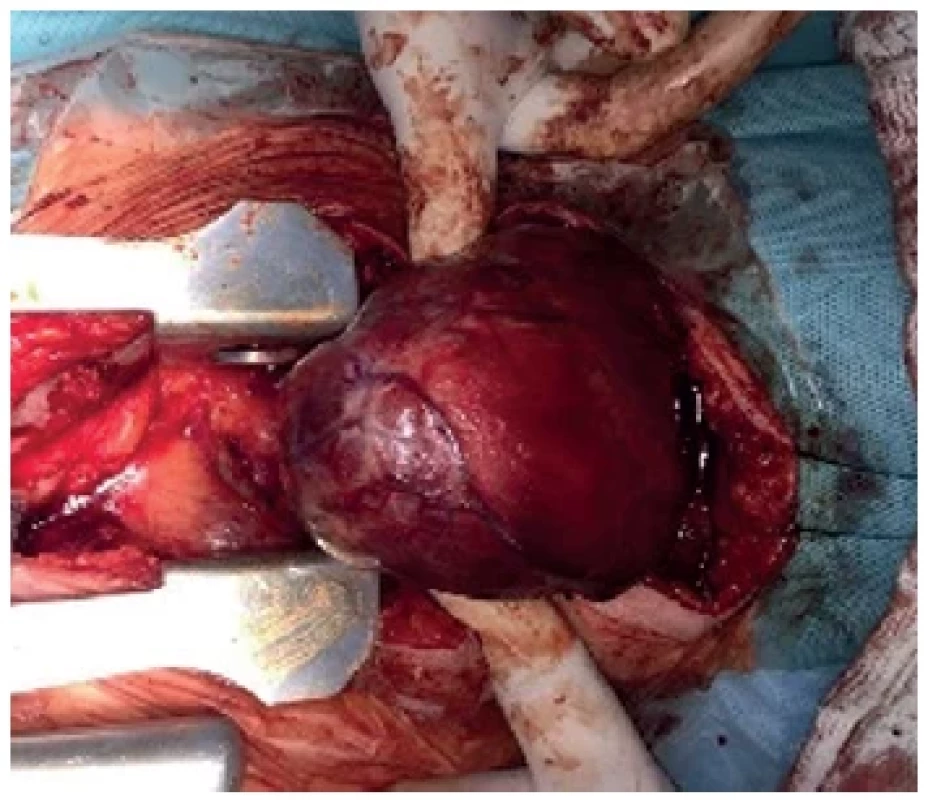 Parciální sternotomie <br> 
Fig. 2. Partial sternotomy