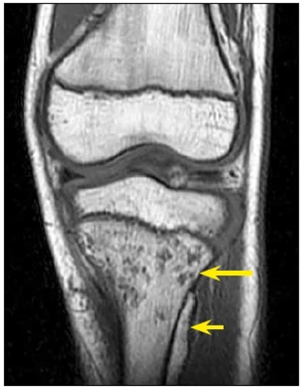 Magnetická rezonance kolene u dítěte se změnou signálu v rozsahu kostní dřeně s obrazem osteomyelitidy (dlouhá šipka) a subperiostálního abscesu (krátká šipka). Všimněte si přítomnosti růstových plotének. [Zveřejněno s laskavým svolením Sawyer JR, Kapoor M. The limping child: a systematic approach to diagnosis. Am Fam Physician. 2009; 79(3):222.]