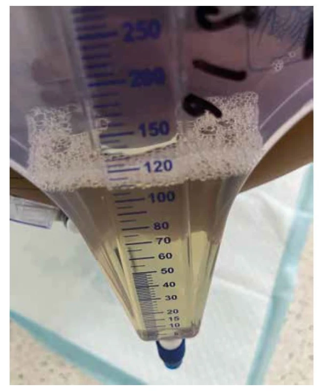 Zelená moč u pacienta sedovaného propofolem