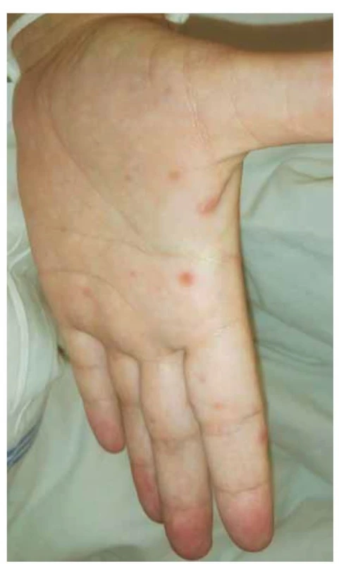Ukázka exantému na dlani pacientky.<br>
Fig. 1. Exanthema on the palm of the patient's hand.