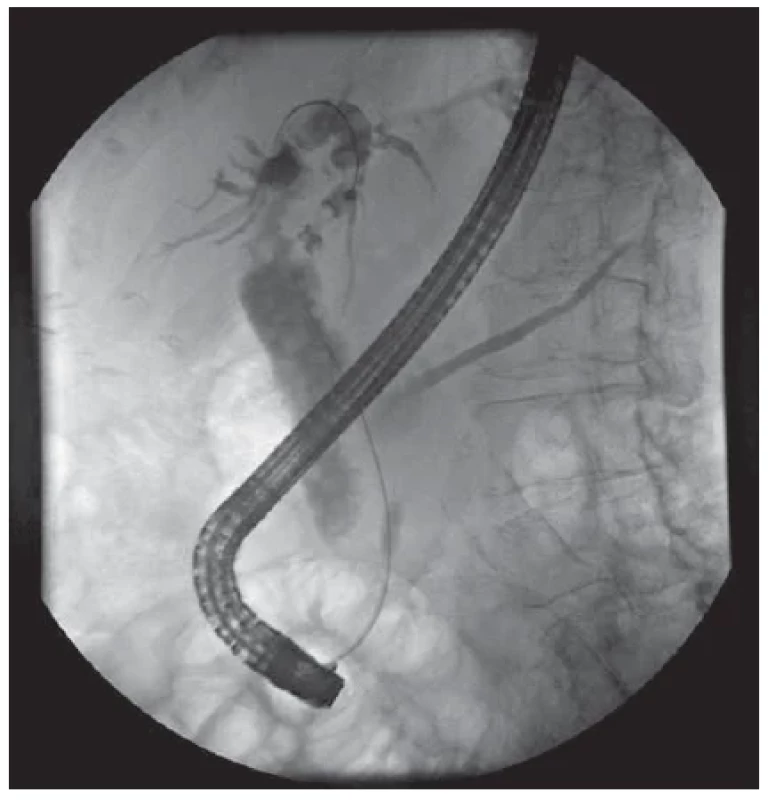 ERCP: masivní dilatace choledochu a intrahepatálních
žlučových cest s vícečetnou litiázou. <br> 
Fig. 1. ERCP: massive dilatation of the choledochus and intrahepatic
bile ducts with multiple lithiasis