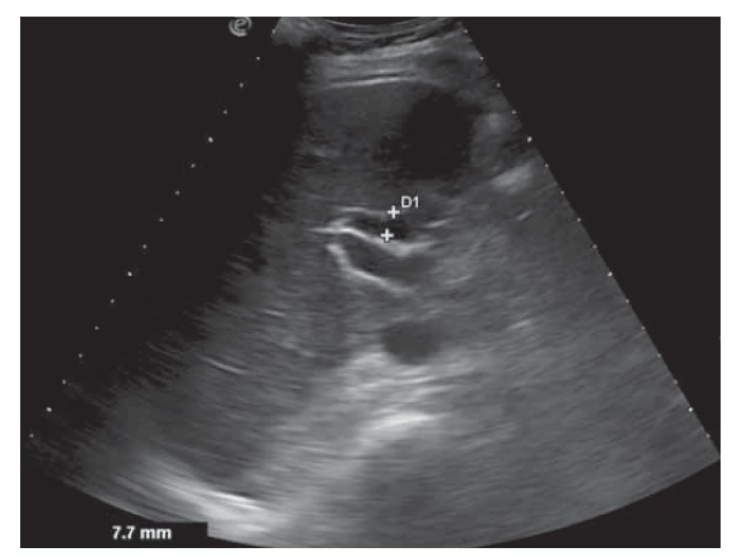 Normálny postcholecystektomický USG nález
ductus choledochus (pri liečbe).<br>
Fig. 3. Normal postcholecystectomy USG finding of common
bile duct (during treatment).