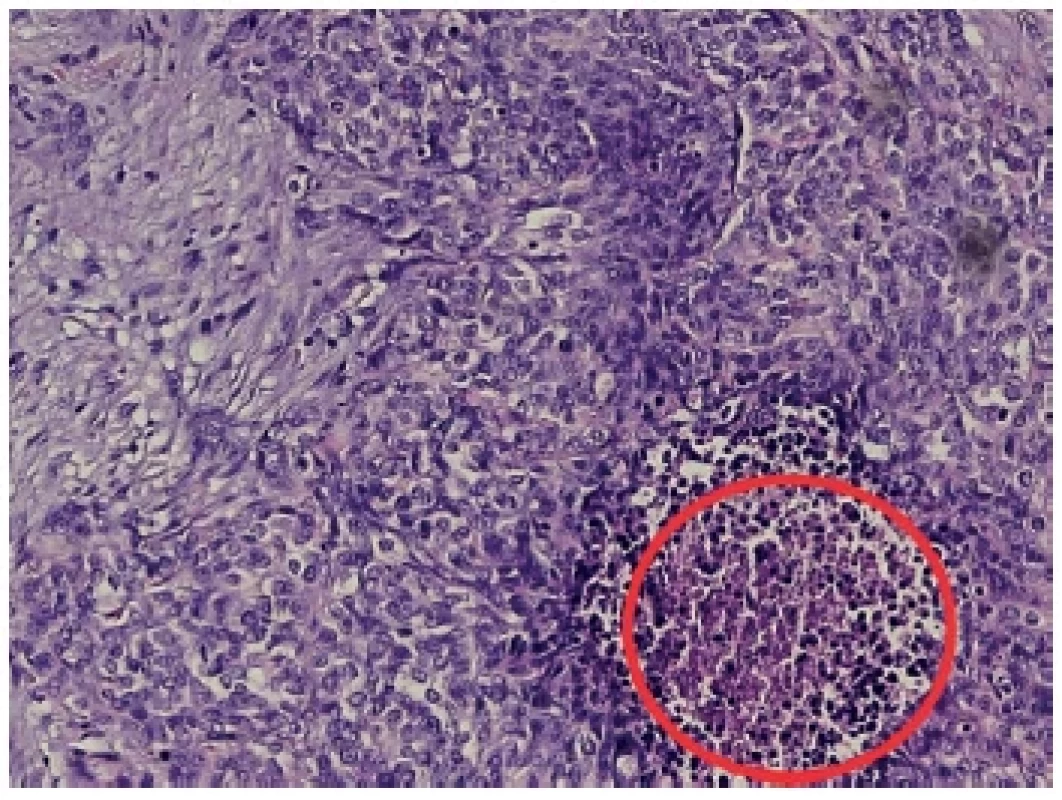Histologický preparát
Barvení hematoxylin/eozin, zachyceny nádorové struktury
s desmoplastickým stromatem, malé hyperchromní buňky
s modrými jádry s pouze ojediněle patrnými nukleoly. V červeném
kroužku označen okrsek nekrózy. <br> 
Fig. 4. Histological sample
Hematoxylin/eosin, captured tumor structures with desmoplastic
stroma, small hyperchromic cells with blue nuclei with
only rarely visible nucleoli. Necrosis in the red circle.