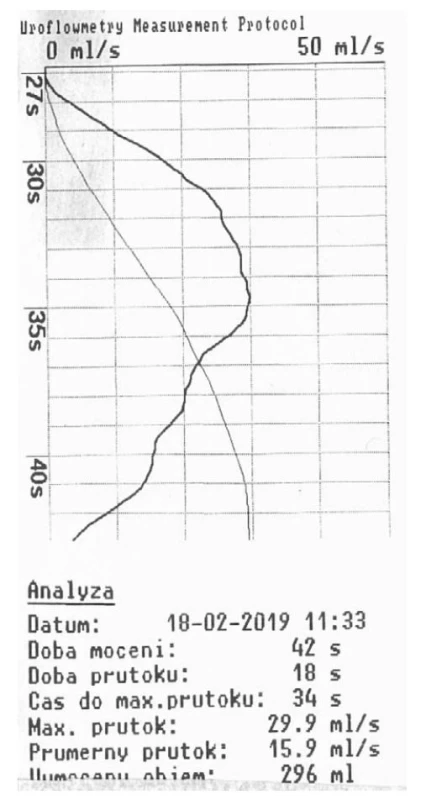UFM tři měsíce od operace: fyziologické hodnoty
průtoků moče, neobstrukční křivka zvonovitého
tvaru<br>
Fig. 8. UFM three months after surgery: physiological
values of urine flow rate; non-obstructive bell-shaped
curve