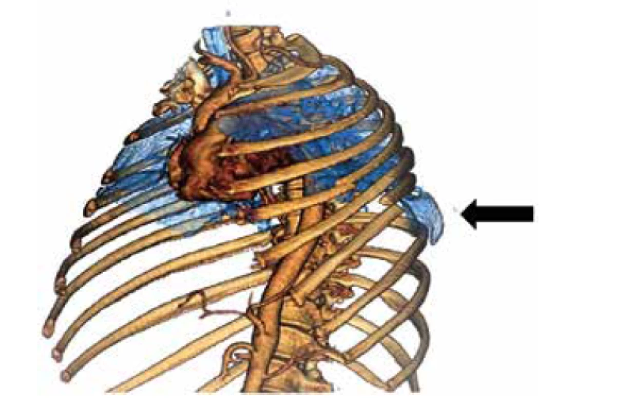 CT 3D rekonstrukce hrudníku, šipka označuje místo
herniace<br>
Fig. 1: 3D CT reconstruction of the chest, the arrow indicates
the point of herniation