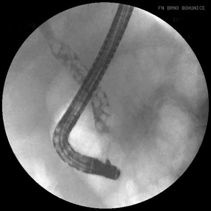 ERCP, četná drobná litiáza v hepatocholedochu<br>
Fig. 1: ERCP, multiple lithiasis in the hepatocholedochus