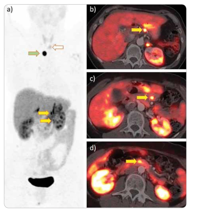 PET/CT s 68Ga-DOTA-TOC u pacientky se syndromem MEN 1, vyšetřované v rámci
kontroly průběhu.<br>
a) Maximum intensity projection: dvě ložiska hyperakumulující ložiska při žaludku (žluté
šipky), později ověřeny endoskopicky a endosonograficky jako NET. Další ložiska v době
psaní textu neverifikována – v mediastinu suspektní paragangliom či metastáza (zelená
šipka) a pod levým lalokem štítné žlázy suspektní adenom či hyperplazie příštítného tělíska
(bílá šipka); b); c) fúze PET/CT: v detailu výše zmíněná hyperakumulující ložiska bez
CT korelátu při žaludku (šipky); d) méně výrazné ložisko v oblasti přechodu hlavy a těla
pankreatu (cytologicky NET).