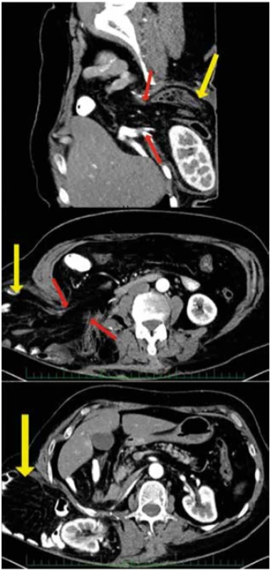 CT vyšetření (kýlní vak označen žlutou šipkou, kýlní branka červenými šipkami) <br>
Fig. 2CT scan (hernia sac marked by the yellow arrow; abdominal defect marked by the red arrows)
