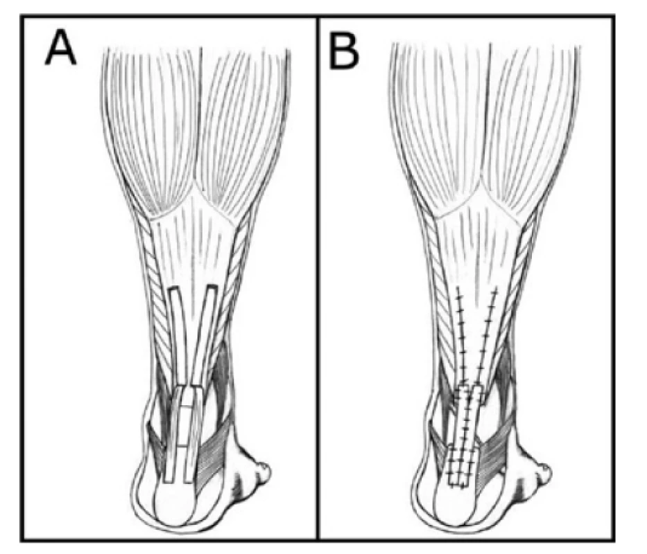 Metody rekonstrukcí defektů Achillovy šlachy:
technika podle Lindholma − A – příprava, B – dokončení<br>
Fig. 5: Methods of Achilles tendon reconstruction: Lindholm
technique − A – preparation, B – completion