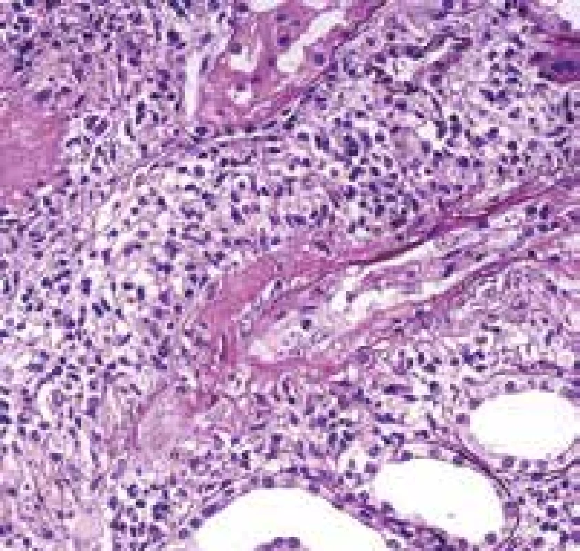 <b>Ledvina s nekrotizující vaskulitidou cévy mimo glomeruly. </b>Stříbření ozřejmí původní nedestruovanou cévní stěnu, fibrinoidní nekróza (šipka) zůstane sytě růžová a vynikne oproti pozadí se zánětem (PASM, Jones methenamine silver s dobarvením).