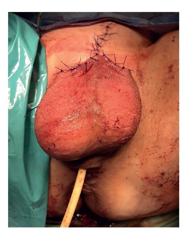 Rekonstrukce kůže šourku a vyšití perineální uretrostomie<br>
Fig. 3: Reconstruction of scrotal skin and perineal urethrostomy