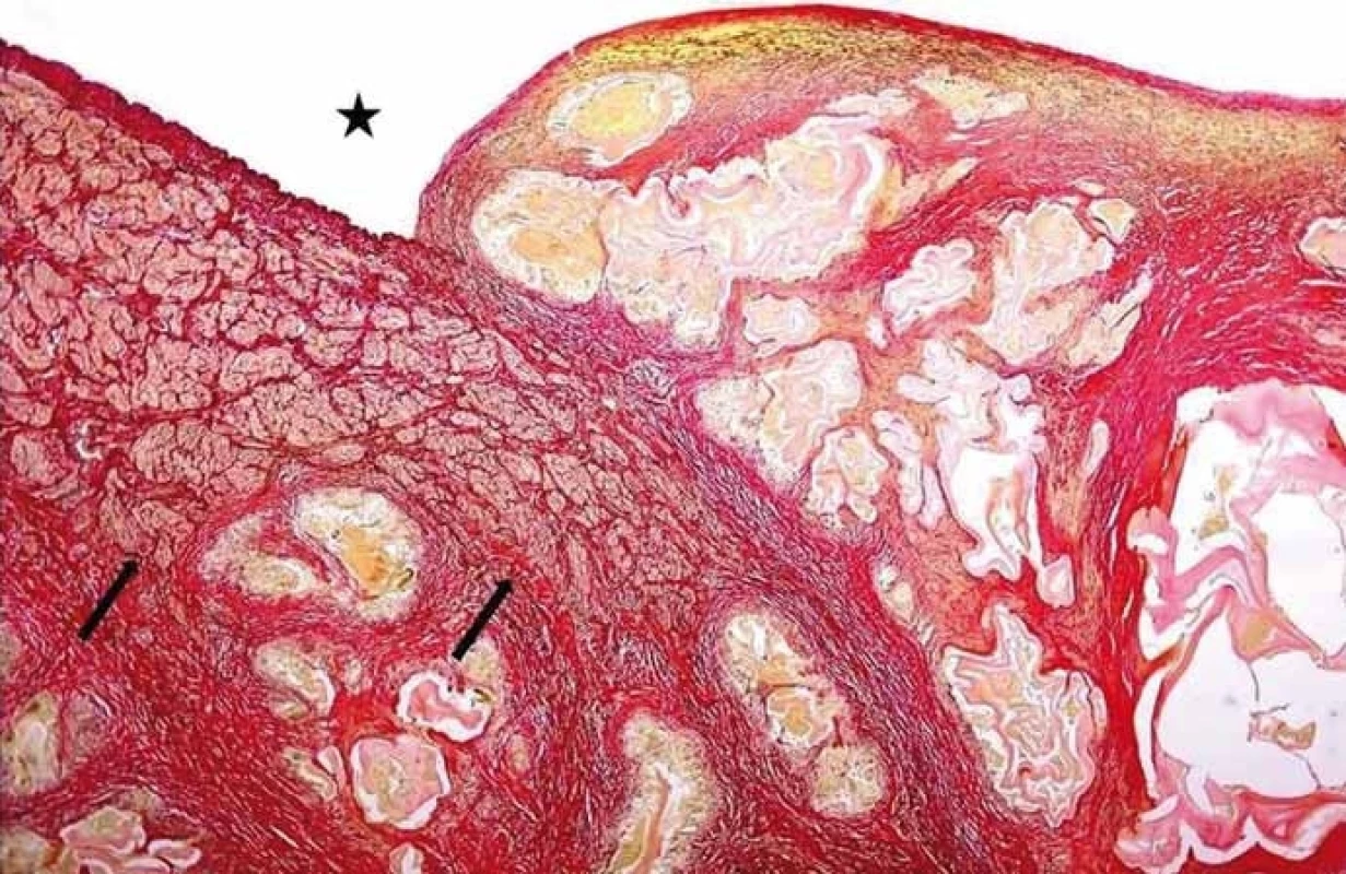 Angioinvaze nevitálních parazitárních struktur echinokoka do cévních struktur. Hvězdička ukazuje lumen cévy, šipky muskuloelastické složky cévní stěny destruované parazitem (barvení SREL, původní zvětšení 100×). (Zdroj: MUDr. Hana Skopcová).<br>
Fig. 1. Angioinvasion of non-vital parasitic structures of echinococcus into vessels. The star shows the vessel lumen; arrows show musculoelastic tissue of the vascular wall infi ltrated by parasitic structures (SREL staining, original magnifi cation ×100). (Author: MUDr. Hana Skopcová).