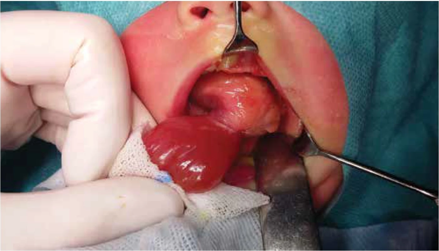 Exstirpace tumoru v lokální anestezii.<br>
Fig. 2. Extirpation of the tumour under local anesthesia.