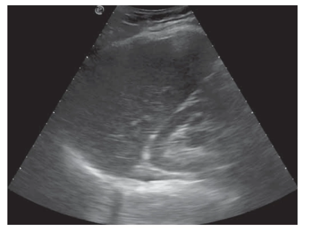Normálna echogenita parenchýmu pečene v rámci
USG vyšetrenia (remisia steatózy následkom liečby).<br>
Fig. 4. Normal echogenicity of liver parenchyma on USG examination
(remission of steatosis due to treatment).