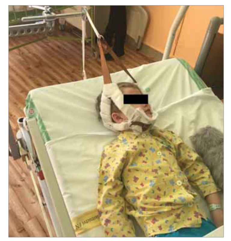 Glissonova trakce a poloha dítěte na lůžku.<br>
Fig. 2. Glisson’s traction and the child’s position on the bed.