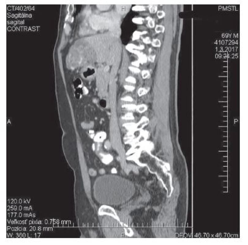CT − koronálny<br>
Fig. 3: CT − coronal
